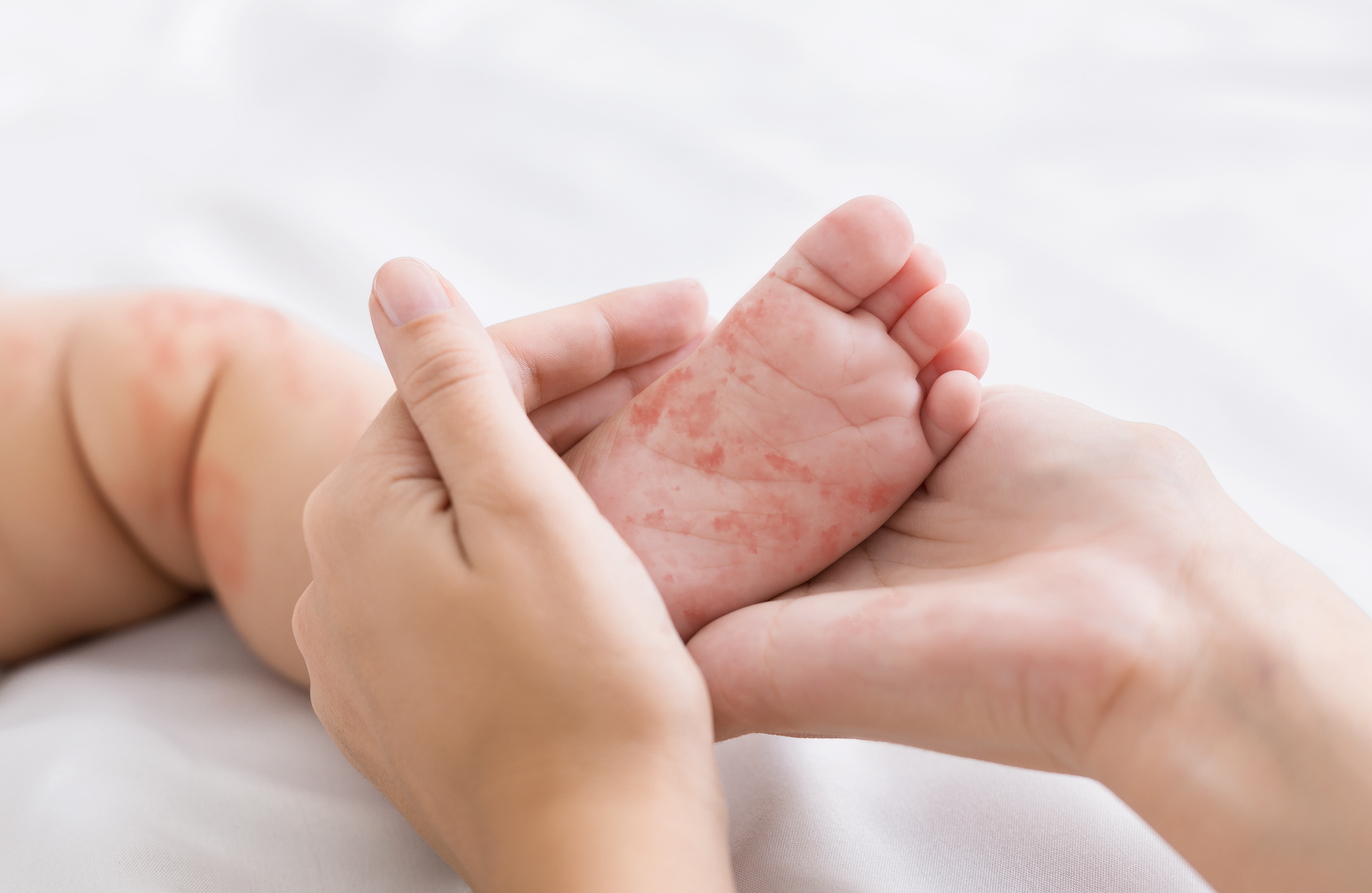 hands holding tiny baby foot with measles rash