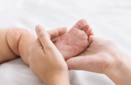 hands holding tiny baby foot with measles rash