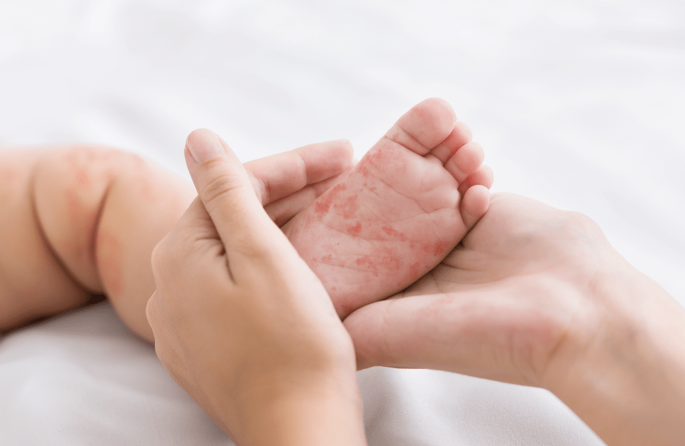 hands holding tiny baby foot with measles rash